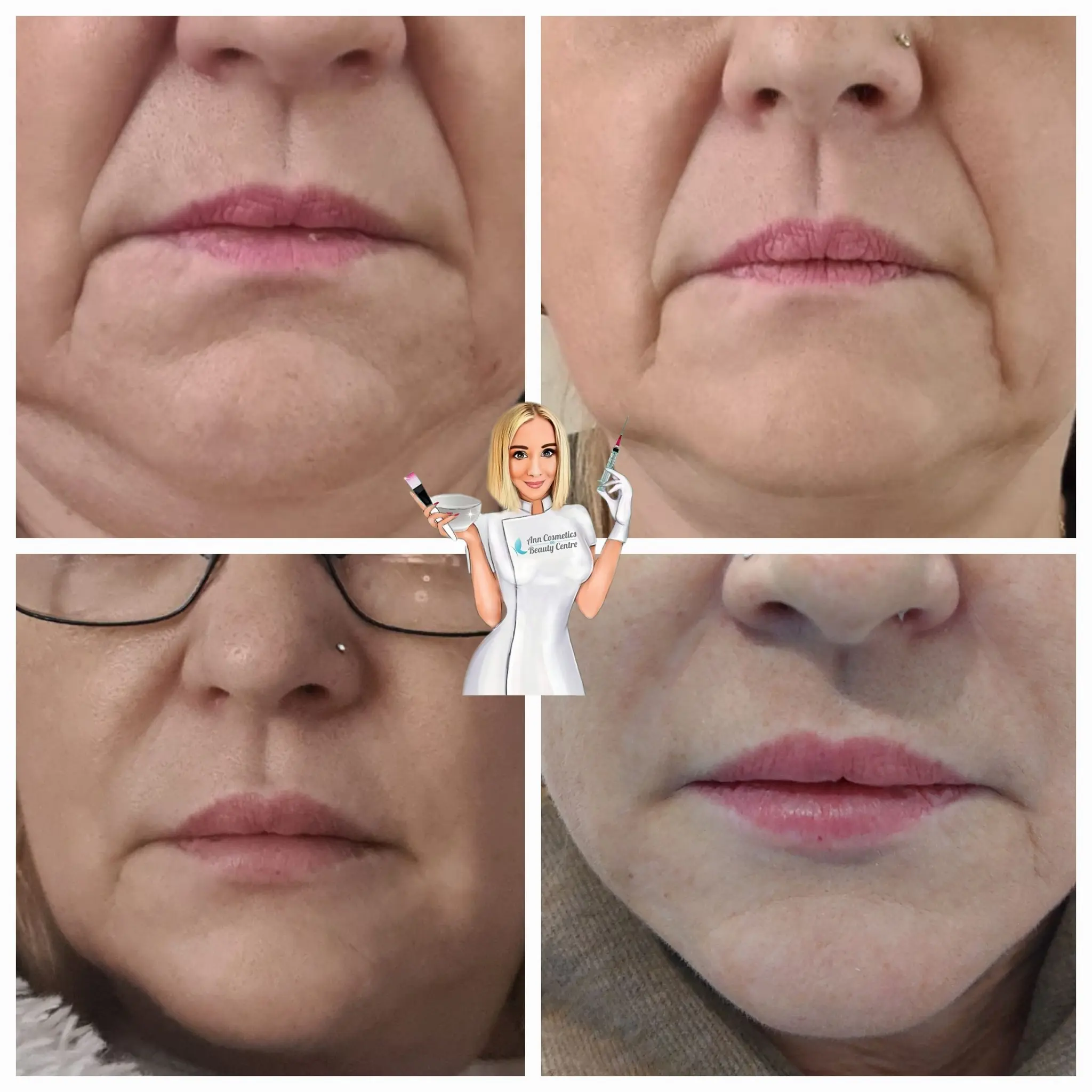 Efekt zabiegu przed i po